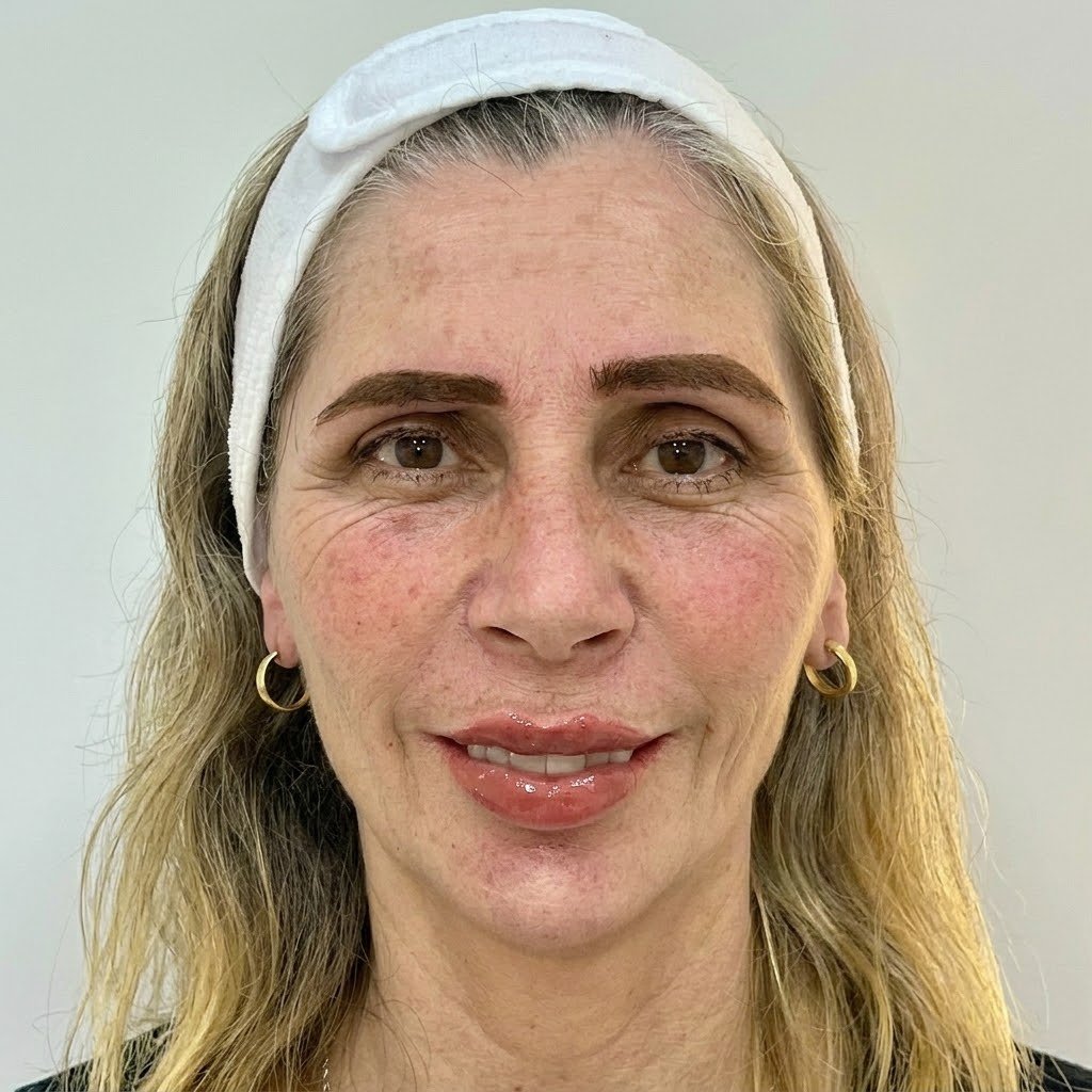Depois Harmonização